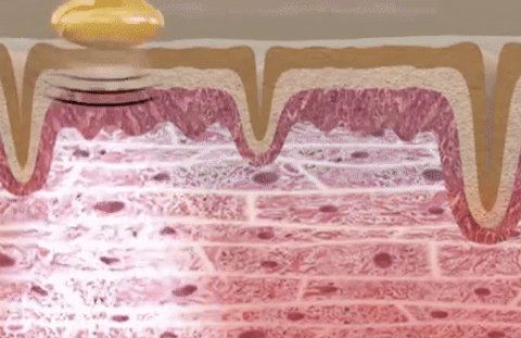 Resultado de imagen de high frequency facial gif