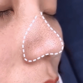 Face Mask For Acne